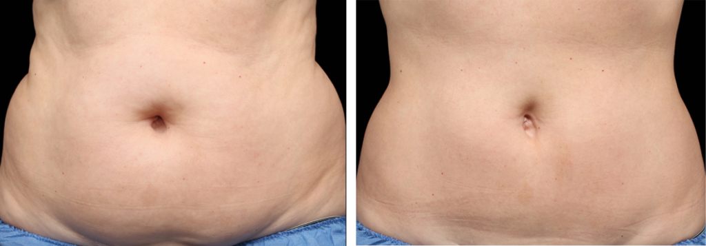 coolscultping love handles muffin tops