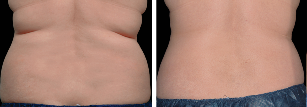 coolsculpting flanks back fat