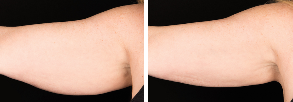 coolsculpting arm fat hanging