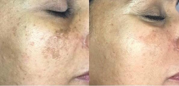 Cosmelan Peel Pigmentation correction