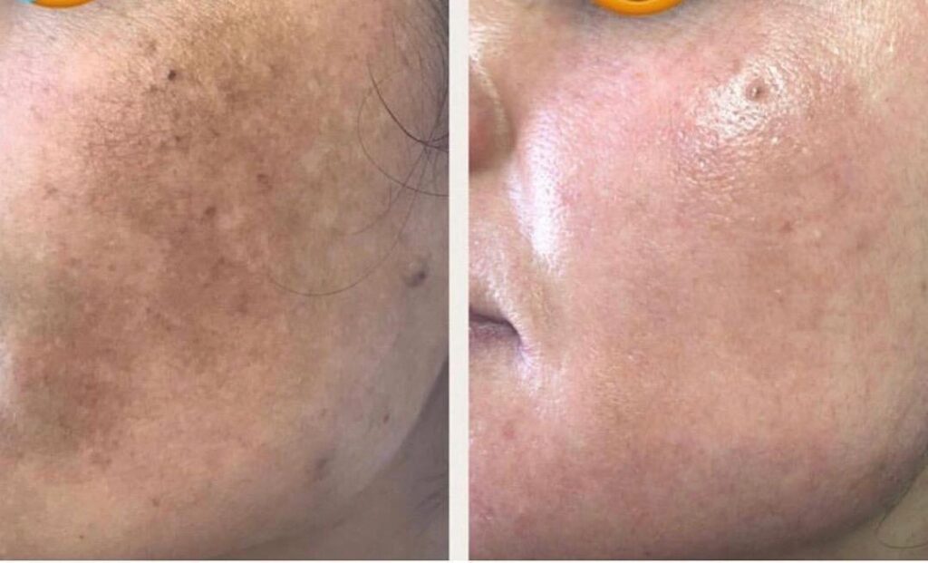 Cosmelan Peel Pigmentation before and after