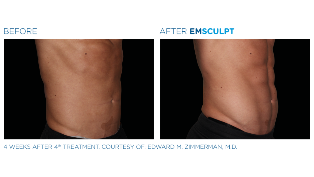 Emsculpt before and after