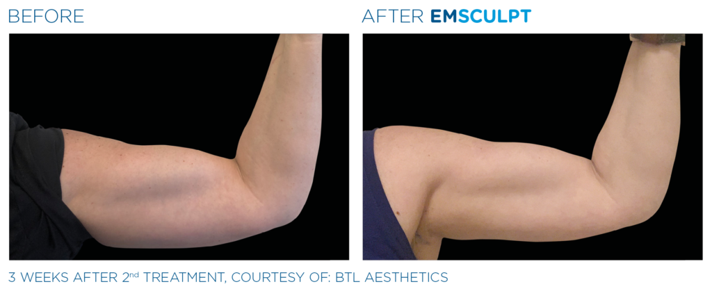 Emsculpt before and after female arms
