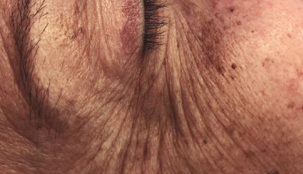 Global Eyecon 2 best undereye treatment in bangalore