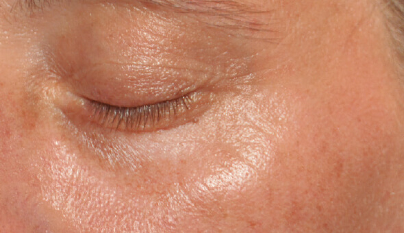 Global Eyecon 5 best dark circle treatment in bangalore