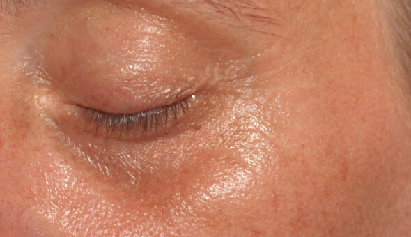 Global Eyecon 4 dark cycle treatment in bangalore