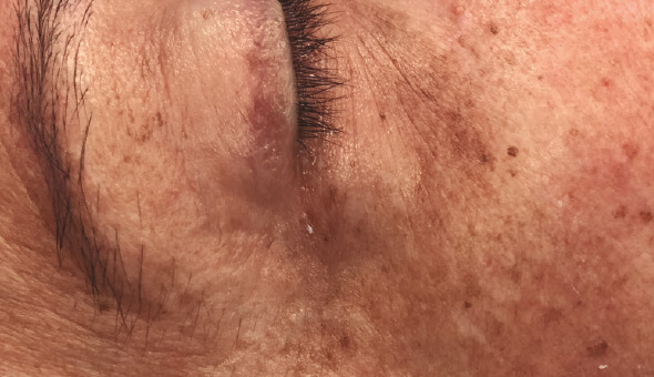 Global Eyecon 3 global eyecon treatment