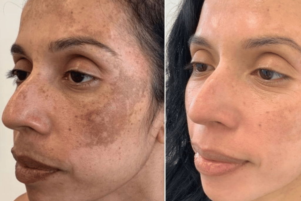 Dermamelan Treatment In Bangalore 5 Before AFter Transformation with DERMAMELAN at Maya MediSpa 2 Maya Medi Spa | Best Beauty Clinic in India
