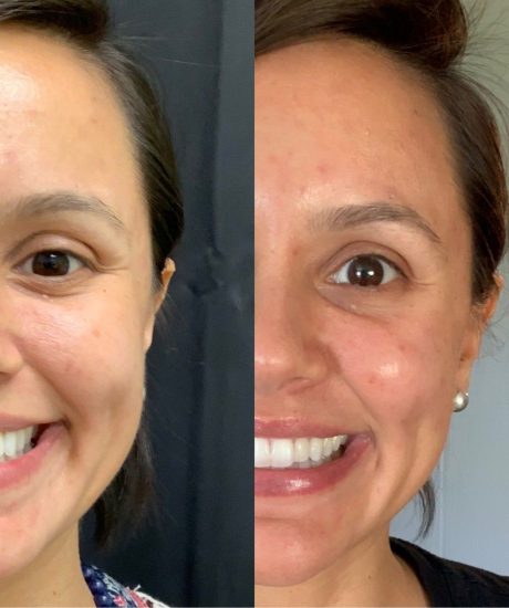 Before After Facelift 1 Maya Medi Spa | Best Beauty Clinic in India