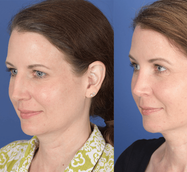 Facial Implants 5 Before After Facial Implants 2 Maya Medi Spa | Best Beauty Clinic in India