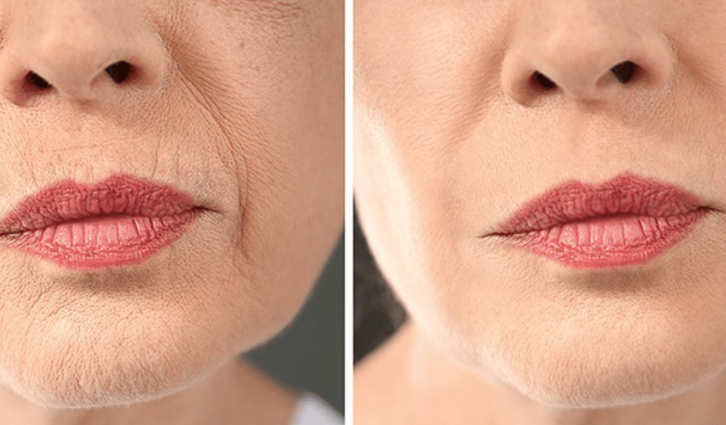 MCT 4 Before After MCT 4 Maya Medi Spa | Best Beauty Clinic in India