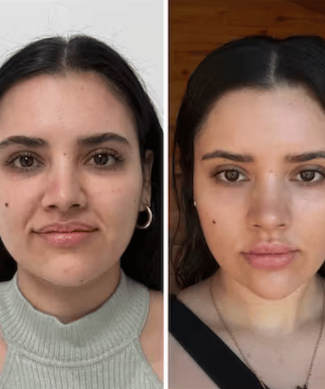 Before After Vampire Facelift Maya Medi Spa | Best Beauty Clinic in India
