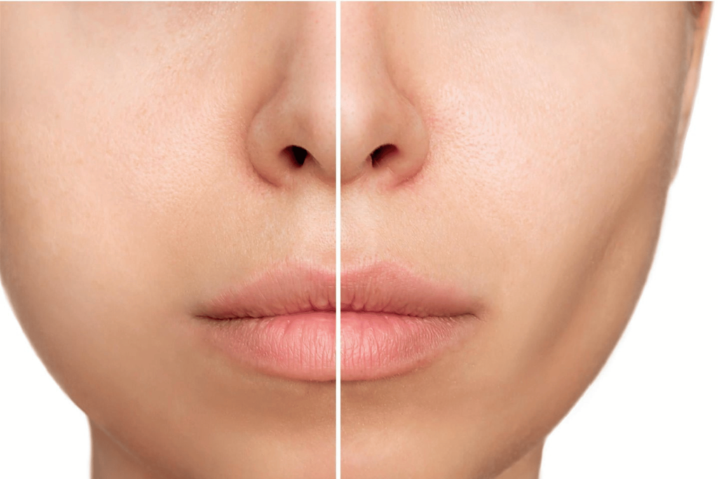 Explore Buccal Fat Removal Transformation 2 Maya Medi Spa | Best Beauty Clinic in India