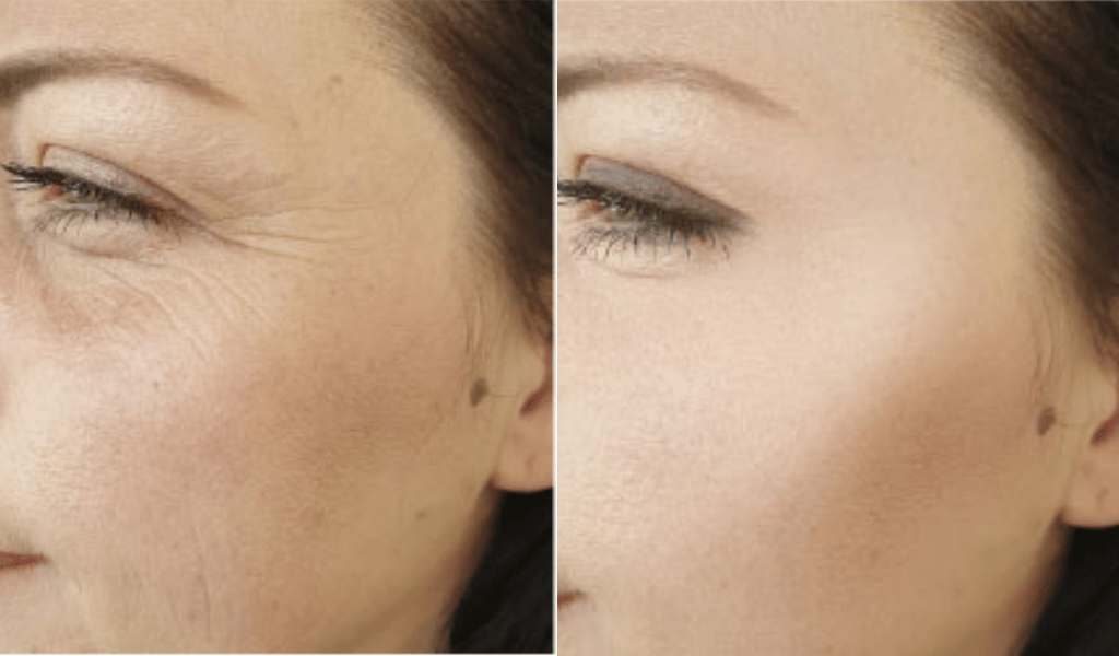 Mesotox 1 Before After Maya Medi Spa | Best Beauty Clinic in India