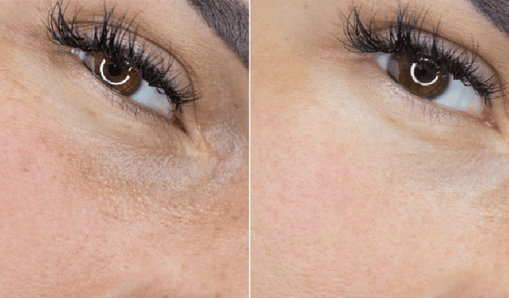Mesotox 2 Before After Maya Medi Spa | Best Beauty Clinic in India