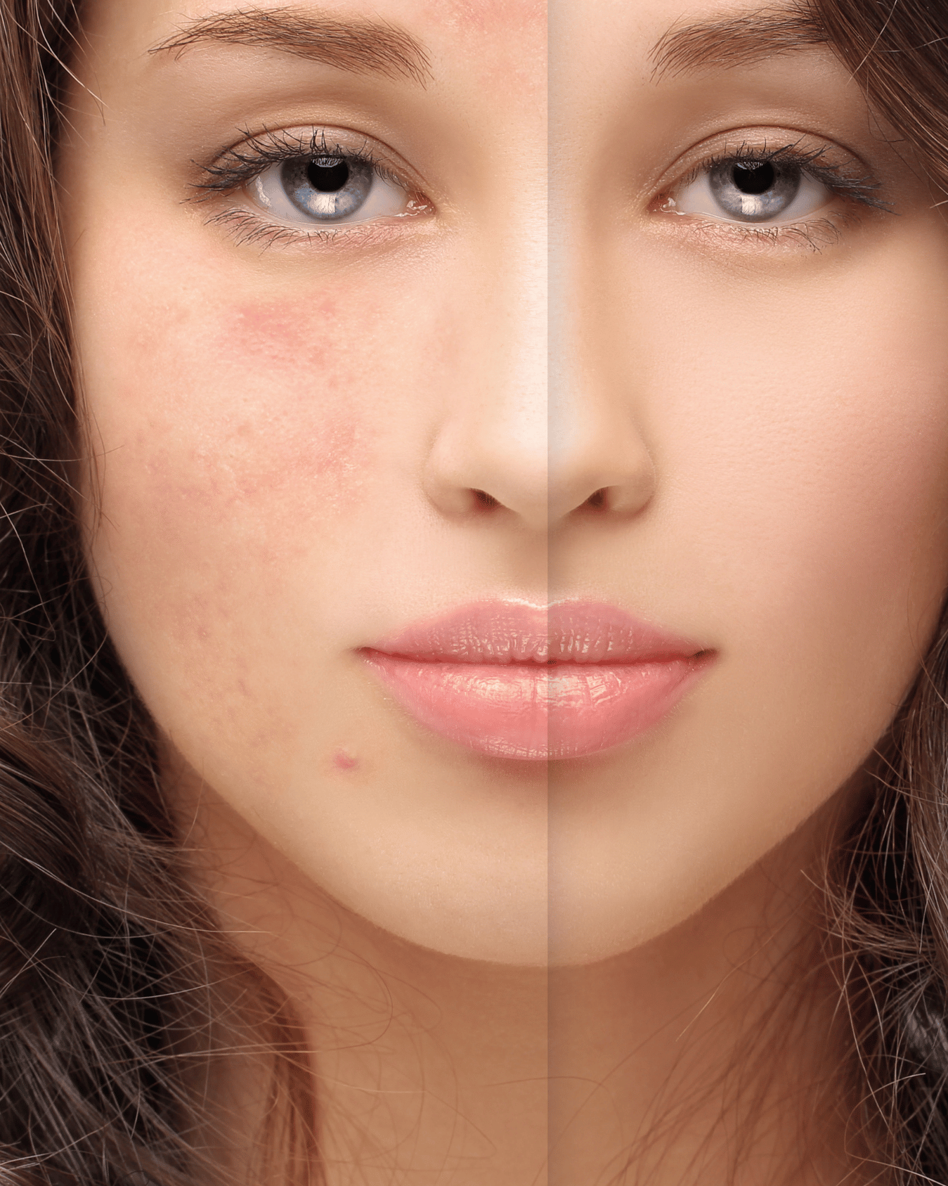Scar Correction 1 Scar Correction Maya Medi Spa | Best Beauty Clinic in India