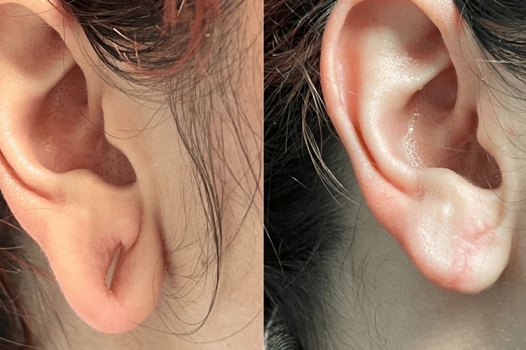 Ear Lobe Repair 3 Why Choose Maya MediSpa for Earlobe Repair 1 Maya Medi Spa | Best Beauty Clinic in India