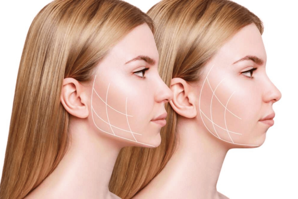 Buccal Fat Removal 3 ey Benefits of Buccal Fat Removal 1 Maya Medi Spa | Best Beauty Clinic in India