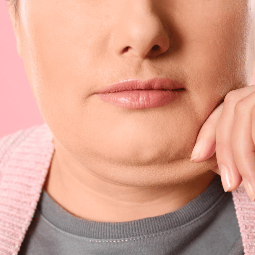 KYBELLA 3 kybella side effects Maya Medi Spa | Best Beauty Clinic in India
